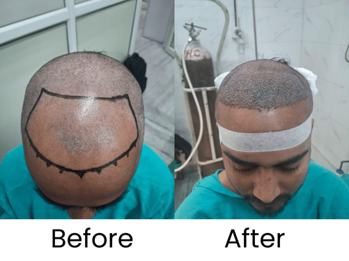 hyperpig-mentation-bf