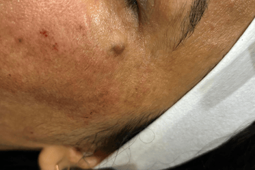 acne scar treatment