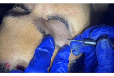 Mole Removal