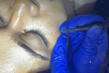 Mole Removal