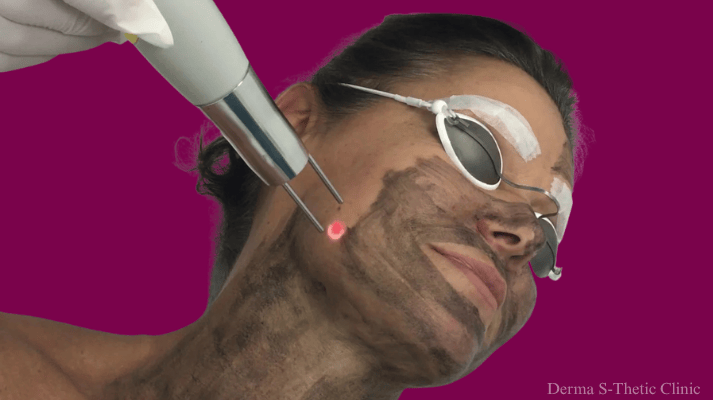 laser-hair-removal treatment