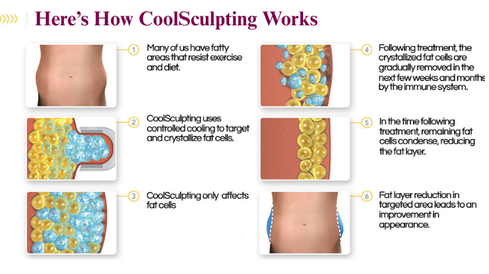 laser-hair-removal treatment