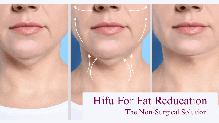 laser-hair-removal treatment